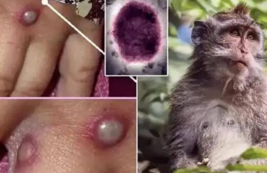Nhiễm virus đậu mùa khỉ có nguy hiểm không