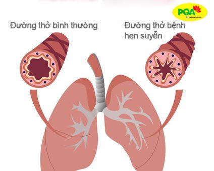 Hình ảnh mô phỏng đường thở khi bị hen suyễn