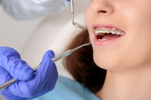Bác sĩ cần gắn khí cụ niềng răng cẩn thận, hạn chế tình trạng rơi mắc cài hay dây cung trong quá trình đeo.